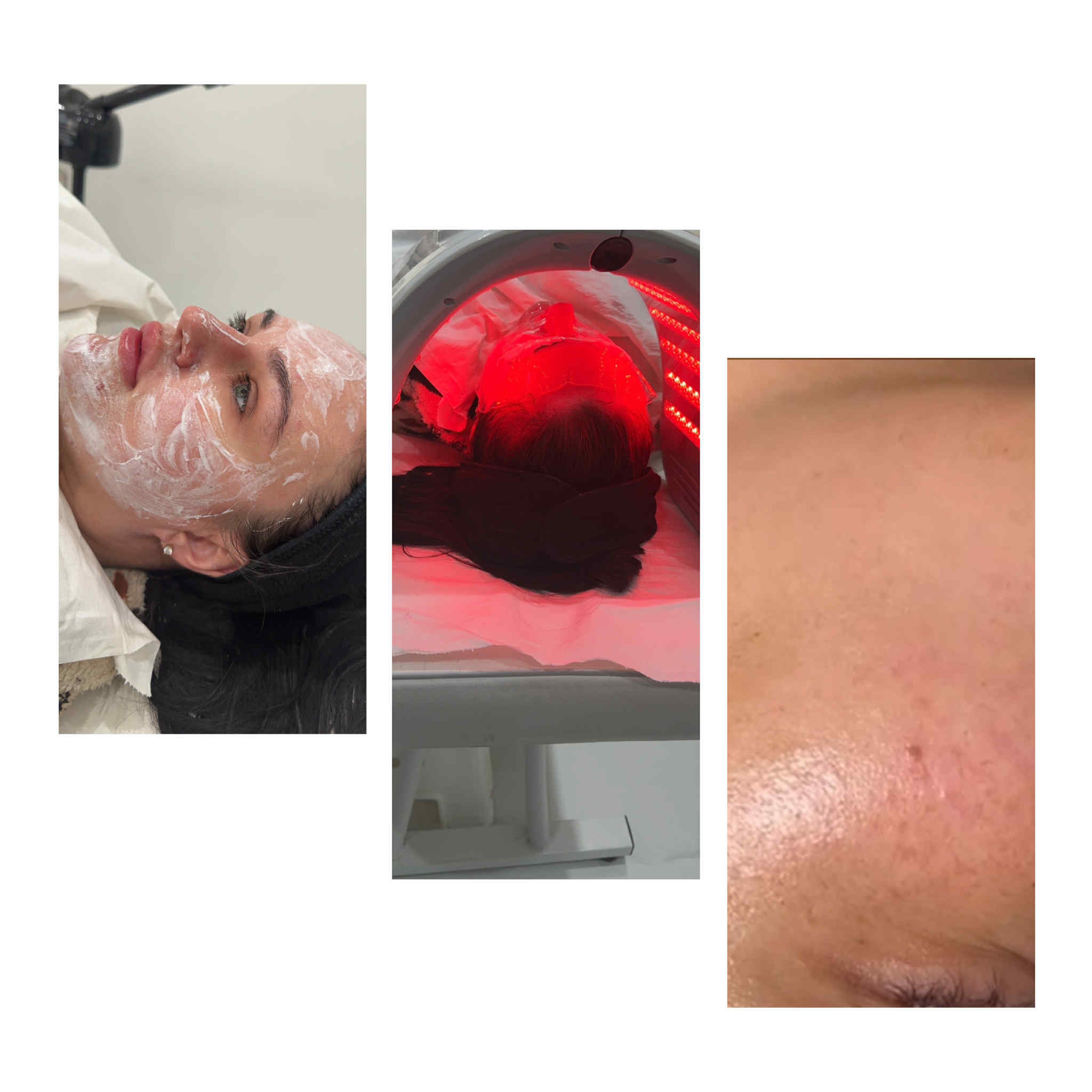 Hydradermabrasion facial for hydration and glow